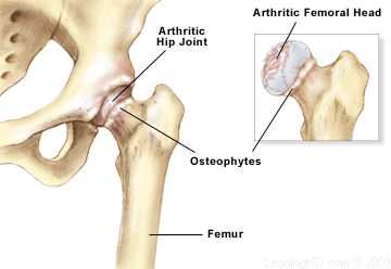 Hip Arthritis Treatment In Bangalore